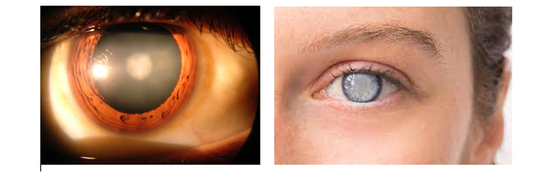 common-eye-diseases