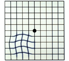 cataract lines grid wavy amsler eye surgery