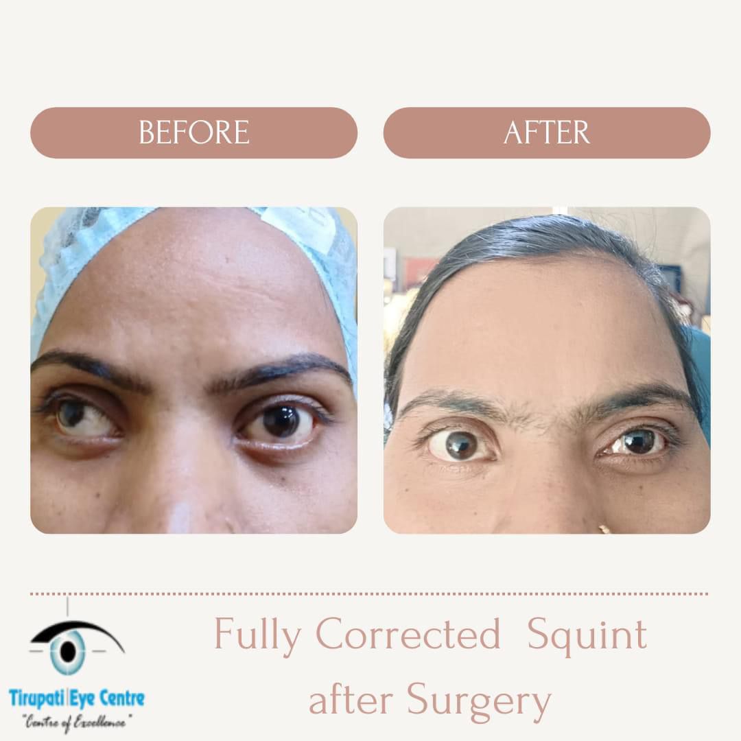 squint-specialist-in-noida